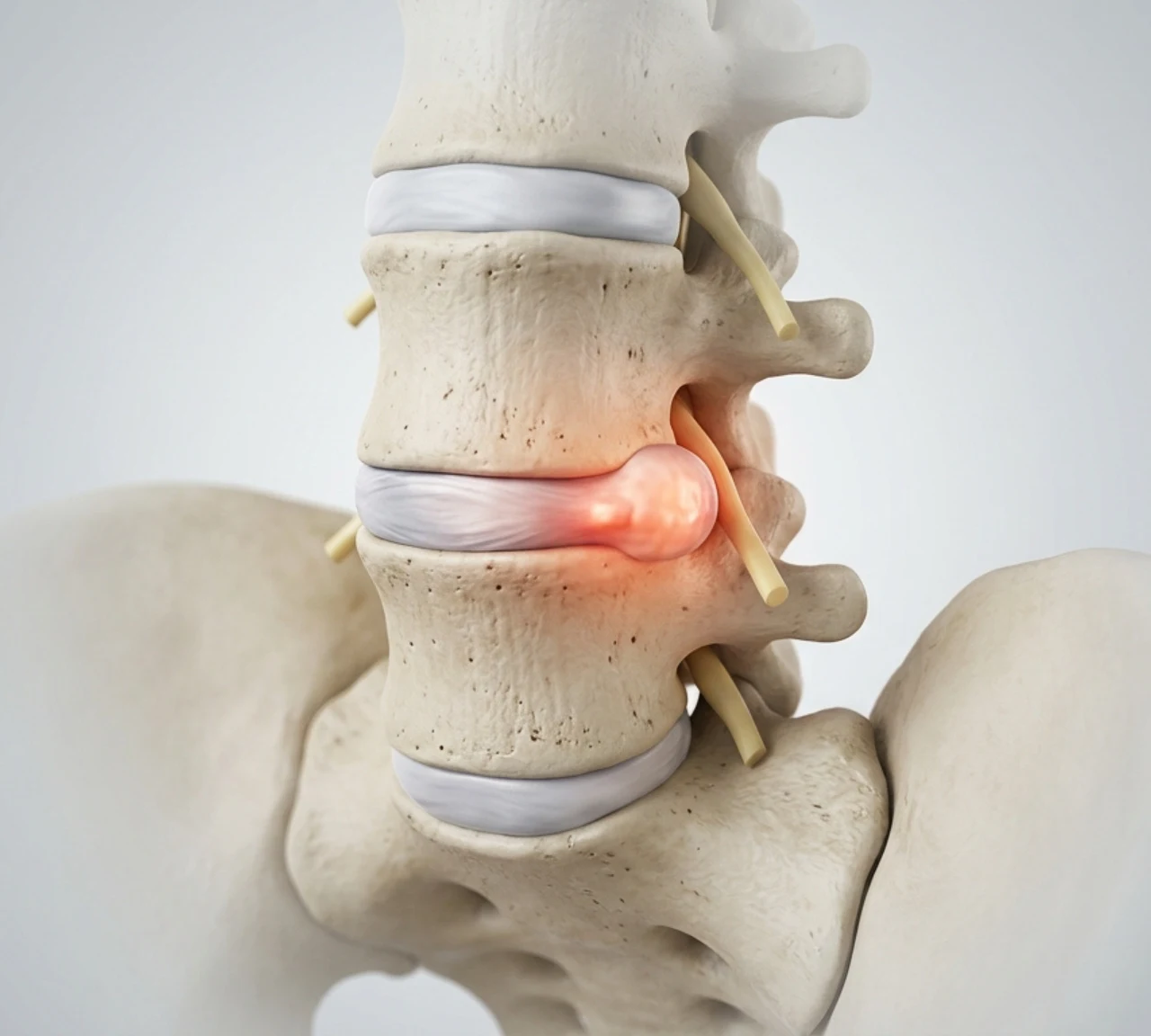 Disc Bulging / Herniation / Protrusion